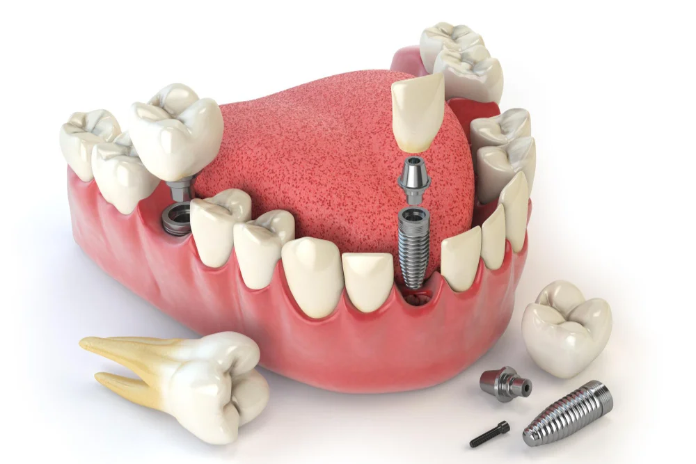 Root Canal Treatment