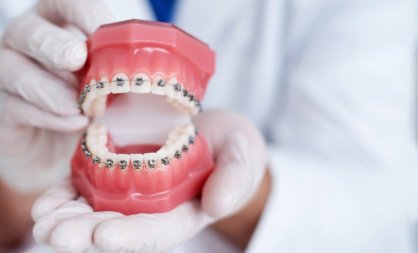 the doctor shows how the system of braces on teeth is arranged